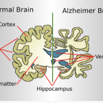 Swedish Researchers Developing Innovative Blood Test for More Accurate Detection of Dementia due to Alzheimer